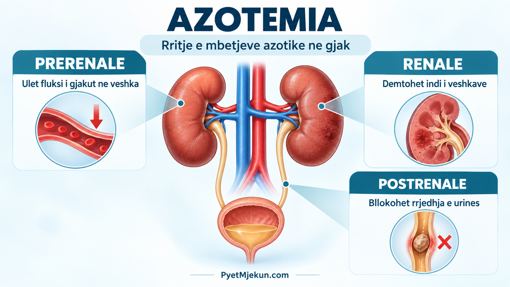 Azotemia prerenale, renale dhe postrenale e paraqitur me veshkat dhe traktin urinar
